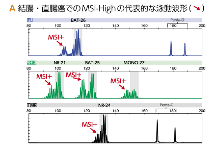 A 結腸・直腸癌でのMSI-Highの代表的な泳動波形