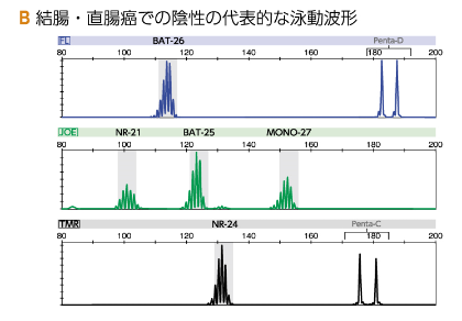 B 結腸・直腸癌での陰性の代表的な泳動波形